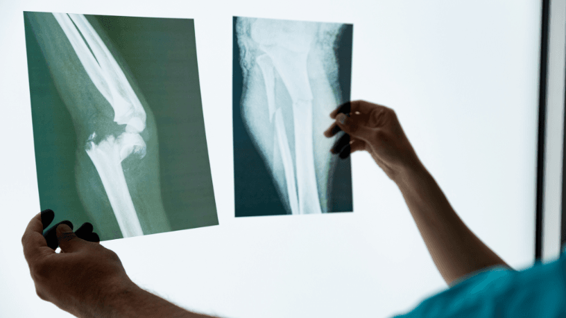 Dra. Thaline Neves revela como a radiologia é essencial para acompanhar e potencializar a reabilitação ortopédica.